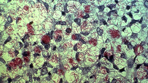  Mycobacterium leprae, חיידק מחלת הנסן, צבוע אדום בצביעת זיהל-נילסן מתוך Wikipedia 